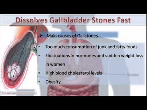 how to dissolve bile stones