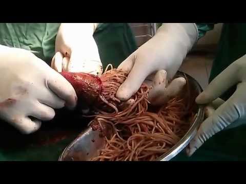 how to know worms in stomach