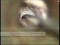 Secretory Otitis Media