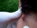 Monstruo del cuello de Marcos (Neck infection)
