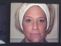 Facial Rejuvenation