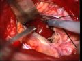 Complete Removal Of The Cerebellum Vermian Tumor