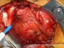 Univers II Techniques- Surgical Approach, Part 2. Univers II Techniques- Surgical Approach, Part 2.