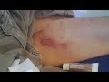 Wheelchair style - Nasty Burn 2nd Degree Burn & taking care of it (Part 8) - L1 injury 4-21-12