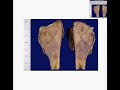 Histopathology Bone-- Osteosarcoma Histopathology Bone-- Osteosarcoma