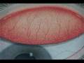 Papillary conjunctivitis.....Grade 1