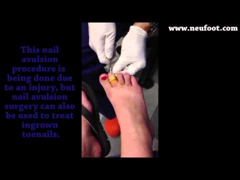 how to treat avulsion