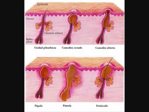 Tratamientos Para El Acne - Como Curar El Acne Naturalmente