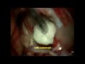 DERMOID CYST BRAIN-suprasellar-intraventricular-microsurgery-dr suresh dugani/HUBLI/KARNATAK/INDIA