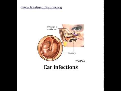 unilateral tinnitus