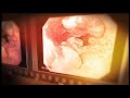 Gastric Cancer Film