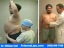 After Liposuction Phoenix - Dr. Hall