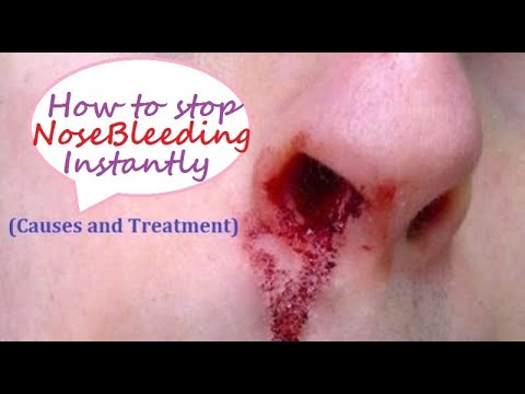 how to treat epistaxis