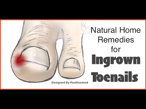 how to get rid of an ingrown toenail