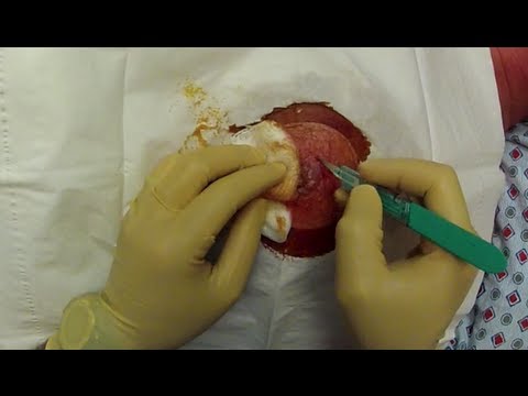 how to drain breast abscess
