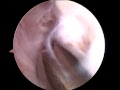 ACL surgery 3/6