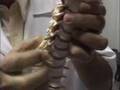 Tratamento de Fisioterapia Manual para Hérnia de Disco