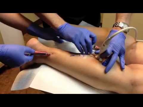 how to get rid of dvt