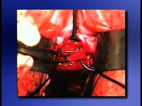 how to repair ureteral injuries