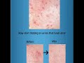 How to remove acne in PhotoShop How to remove acne in PhotoShop