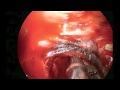 Endoscopic Removal of Pituitary Tumor Endoscopic Removal of Pituitary Tumor