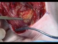 www.primalpictures.com Surgical Procedure - Neck Dissection. Neck dissection is a surgical procedure that involves the removal of neck lymph node metastases.