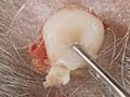 Pilar Cyst Appearance