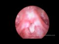 www.PerformanceVoiceSolutions.com ~ When vocal cords move normally, you have a clear voice. Videostroboscopy allows a voice specialist to see very small changes in your vocal folds' ability to vibrate. Then create a therapy program for the individual patient. http www.TotalHearingSolutions.com http