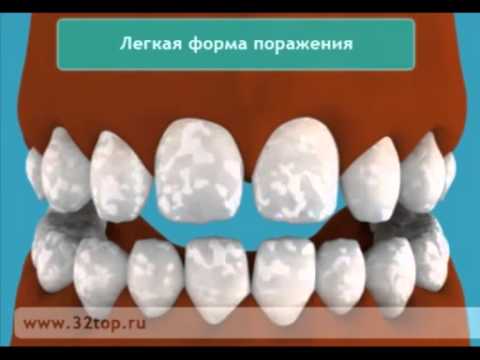 белая эмаль для зубов видео белая эмаль для зубов видео
