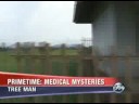 Meet Dede Koswara, the \"Tree Man\". From ABC News