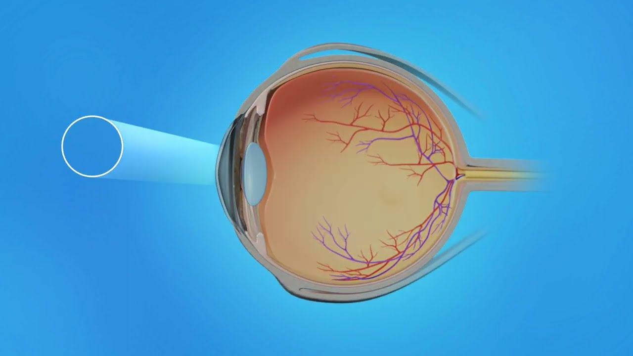 Retina Diabetic Laser Macular Edema