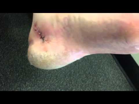 Tarsal Tunnel - Post-Op - 2