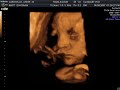 3D/4D Ultrasound at 33 weeks - �chographie 3D/4D 33 semaines