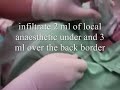 superficial cervical plexus block ultrasound guided
