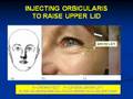 videos de Botox lecture IMCAS Paris 2007 (Dr. Patrick Treacy)