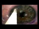 lasik eye sergery