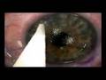 lasik eye sergery lasik eye sergery