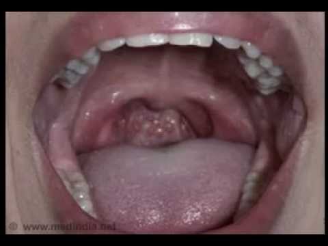 how to cure a sore throat uk