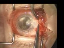 Multi-Layered Amniotic Membrane Transplantation