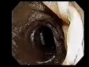 Dr. Shinya - Kangen Water - Part 1 Small Intestine Cancer