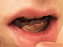 Vidblog 6 - Gum Graft