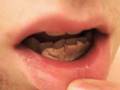 Vidblog 6 - Gum Graft