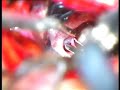 Click here to watch this video Patient F 53Y with ICA rutpured anevrism at the bifuraction of PCoA and AChA.avi