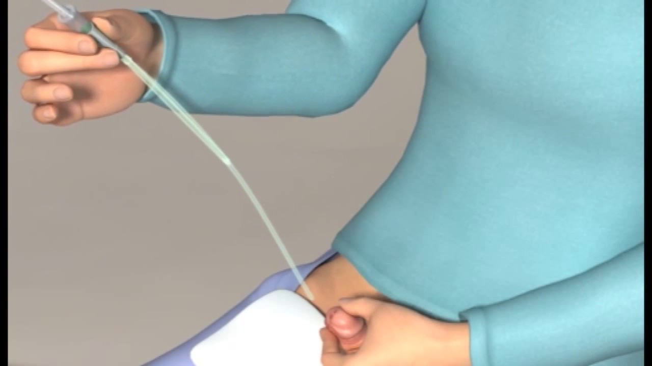 How to Use SpeediCath Compact Male Catheter Personally Delivered Blog