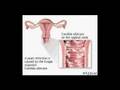 Yeast Infection home cures and remedies yeast infection