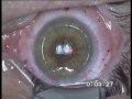 Femto-Lasik Procedure
