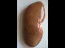 Polycystic Kidney Disease(PKD) Polycystic Kidney Disease(PKD)