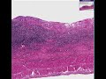 Histopathology Small intestine, ileum--Typhoid ulcer