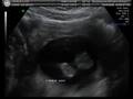Baby Girl Yandle 20 Week Ultrasound