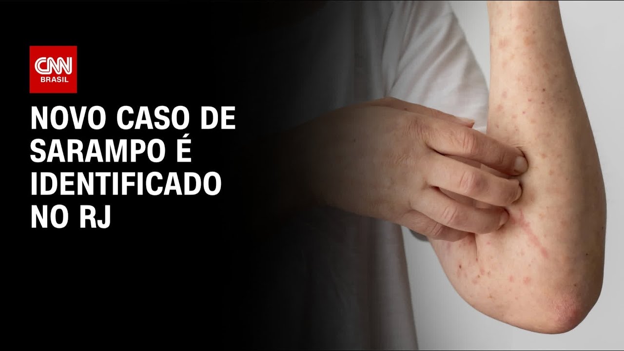 Novo caso de sarampo é identificado no Rio de Janeiro | BASTIDORES CNN